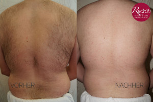 Dauerhafte Haarentfernung in München