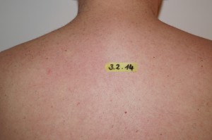 Rückenenthaarung mit IPL bei Redröh Kosmetikstudio in München